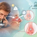 How Cocaine Damage Nasal Septum Happens